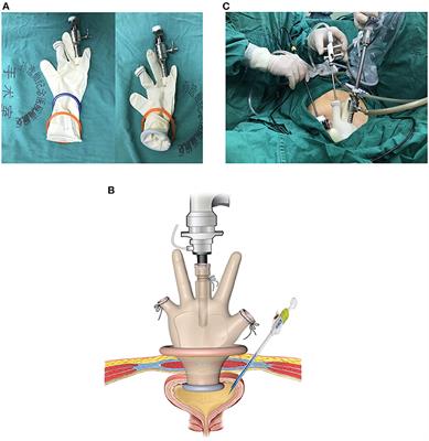 Suprapubic Transvesical Repair of Vesicovaginal Fistula Using a Homemade Laparoscopic Single-Port Device: Experience of 42 Patients